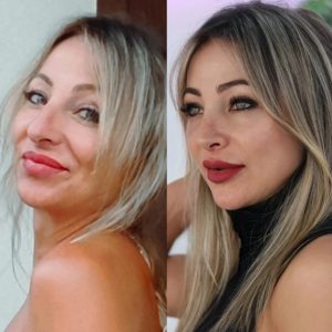 antes y después de la rinoplastia ultrasonica