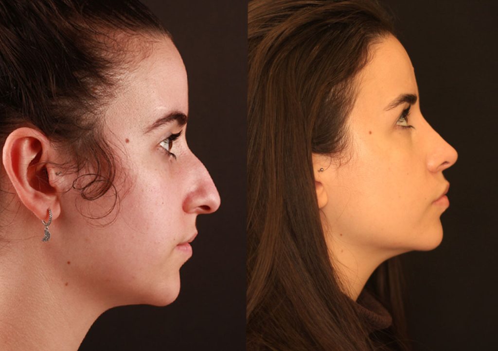 antes y después de la rinoplastia ultrasonica