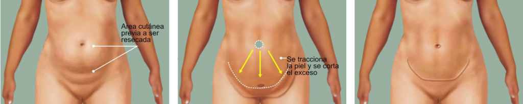 Una imágen ilustrativa que explica como se realiza la intervención de la abdominoplastia.