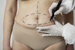 abdominoplastia en girona