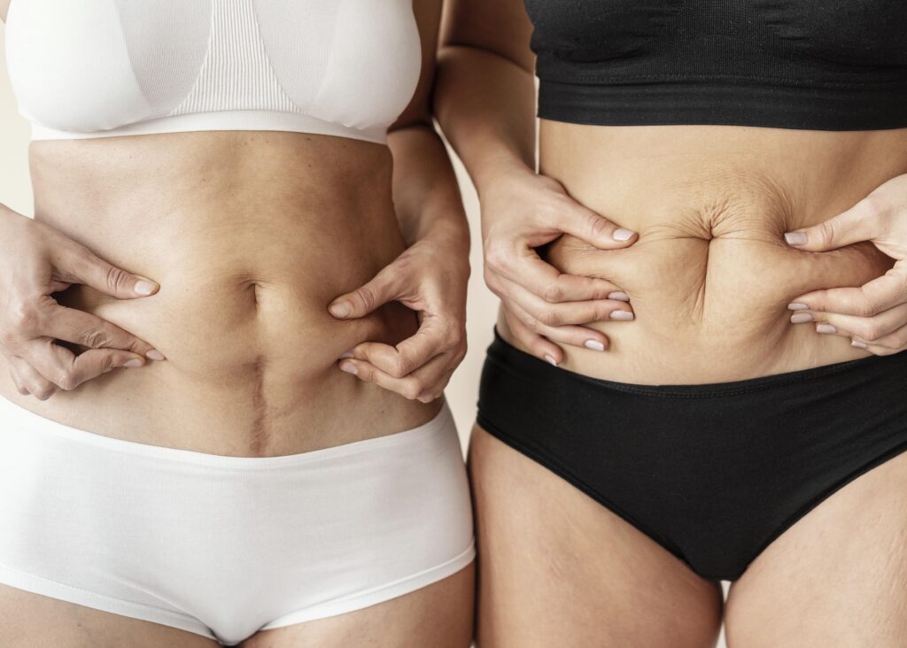 abdominoplastia