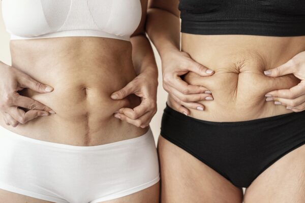 Abdominoplastia: Tu Nueva Silueta, Tu Nueva Confianza