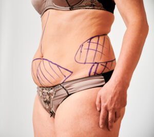 abdominoplastia y liposuccion